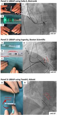 A Guide to Left Bundle Branch Area Pacing Using Stylet-Driven Pacing Leads